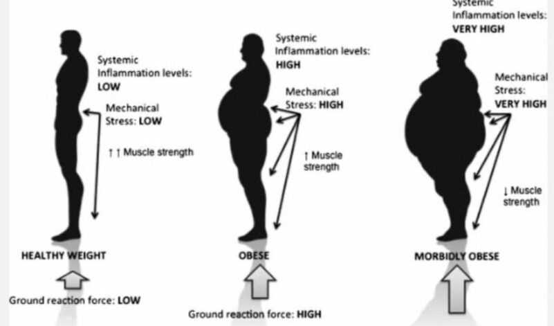 LOW BACK PAIN (LBP)