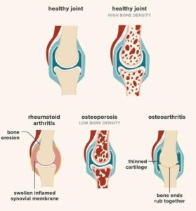 OBESITY AND OSTEOARTHRITIS